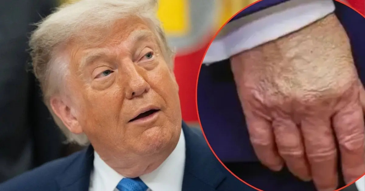 What's Really Going On With Trump's Health? Scans, Bandages and Growing Questions